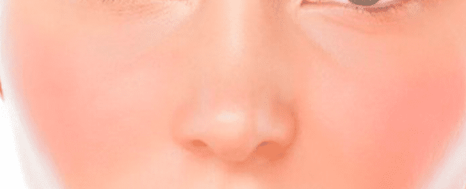 Image showing a skincare product designed to reduce rosacea and soothe sensitive skin at home.