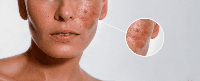 Learn how to address hyperpigmentation with effective skincare strategies. Discover prevention tips and treatment approaches to improve skin tone and reduce dark spots