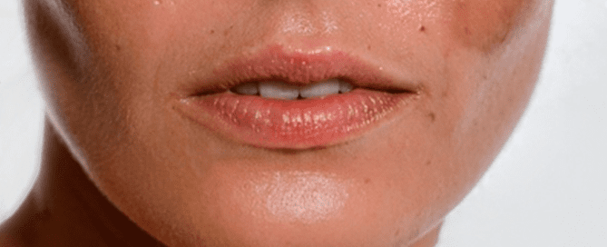 Learn how to address hyperpigmentation with effective skincare strategies. Discover prevention tips and treatment approaches to improve skin tone and reduce dark spots